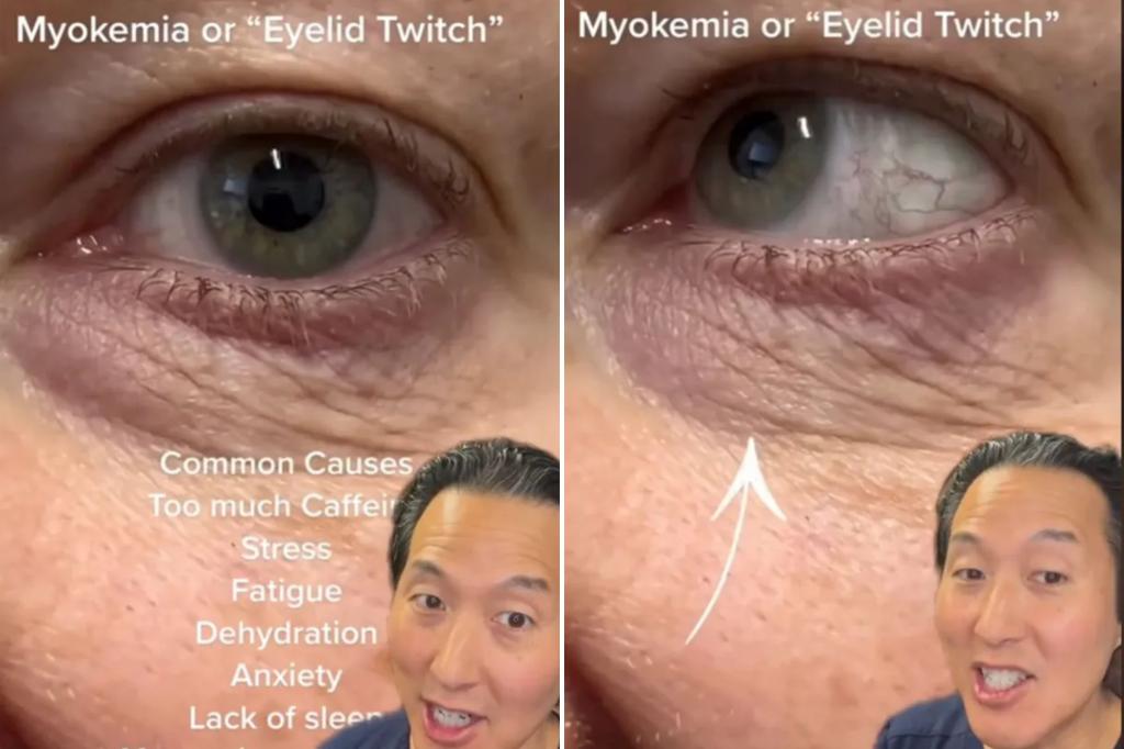 Doctor reveals 3 ways to stop eyelid twitching, known as myokymia